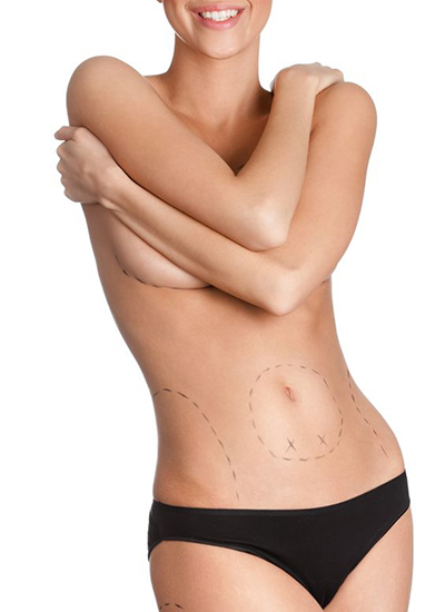 Liposuction Dr. Tribull Berlin